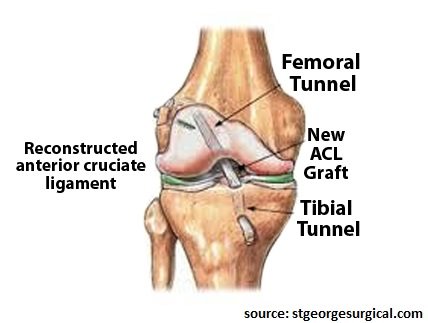 procedure for ACL reconstruction