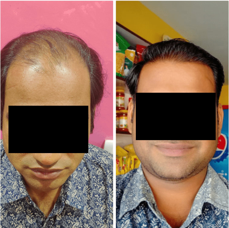 Hair Transplant Cost in Jaipur | Rejuvena Cosmo Care Hair Transplant Cost in Jaipur | Rejuvena Cosmo Care