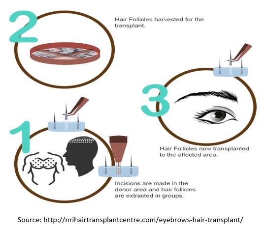 Eyebrow hair Transplant