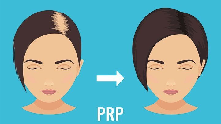 PRP Treatment