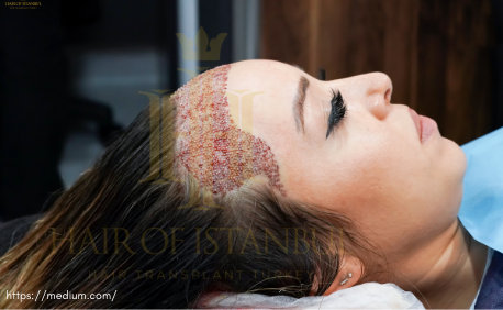 Female Hair Transplant