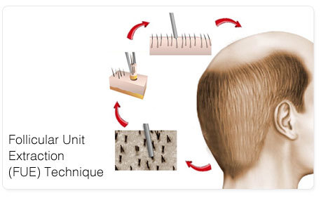 Follicular Unit Extraction
