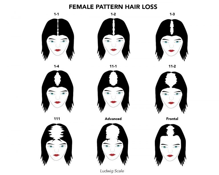 Female Hair Loss Pattern