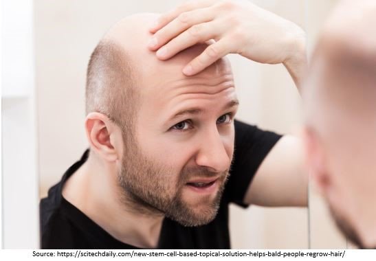 hair transplant image