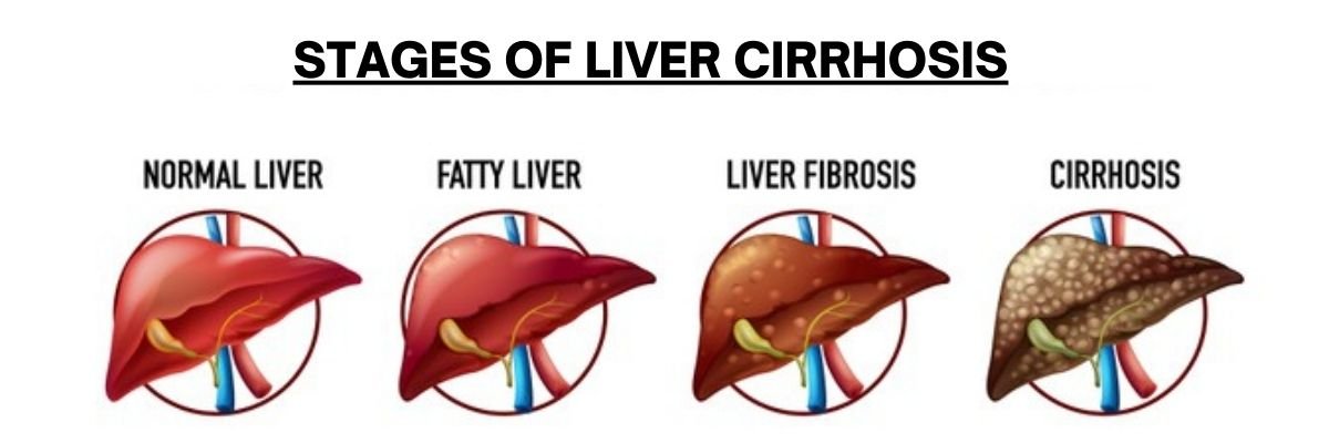 What Is Cirrhosis? What Is Cirrhosis?