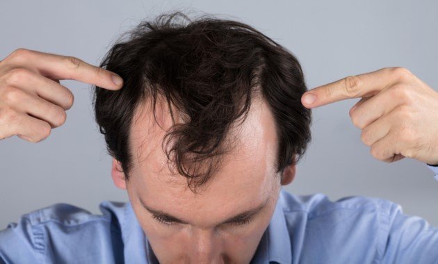 Hair Transplant In India