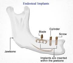 Types of dental implants