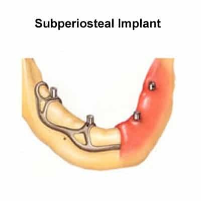 Dental Implants
