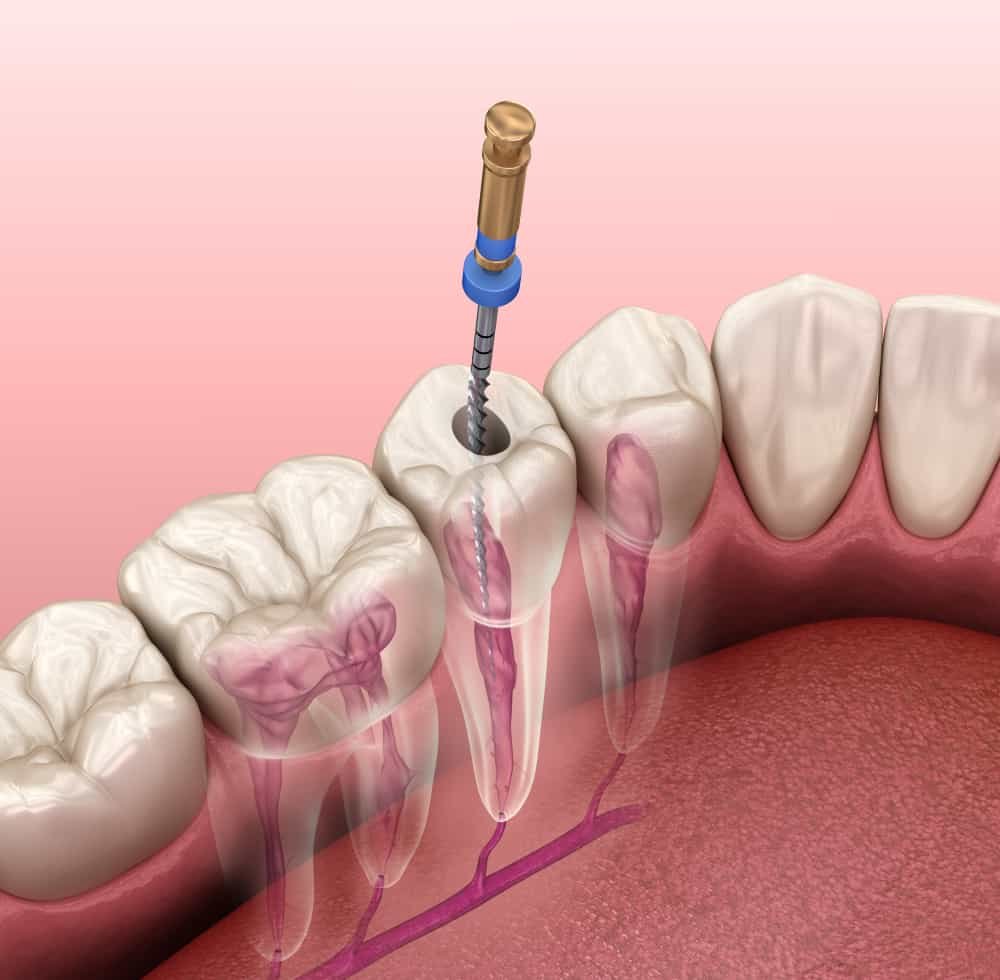 Root Canal treatment in Noida