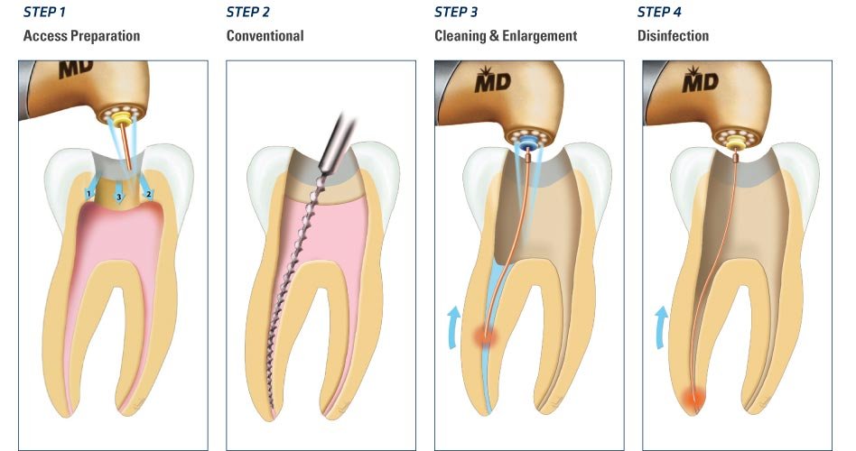 Root Canal treatment in Noida