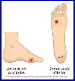 diabetes effect on foot
