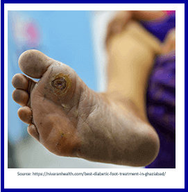 Diabetic neuropathy