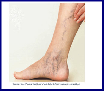 Peripheral vascular disease