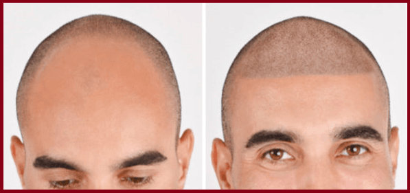 Micro scalp pigmentation SMP  Hair pigmentation treatment hairline  tattoo