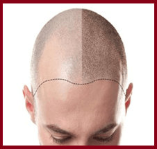 scalp micropigmentation in mumbai