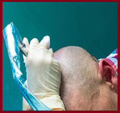 scalp micropigmentation process