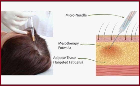 mesotherapy procedure at Rejoice Hair Transplant