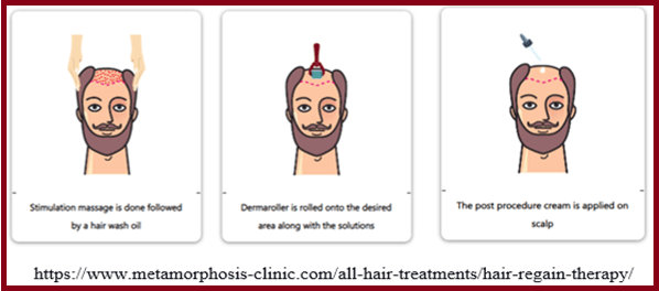 micro needling procedure