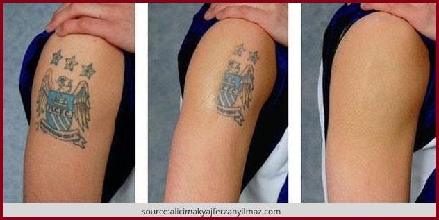 Laser Tattoo Removal Rochester Medway  PureLite