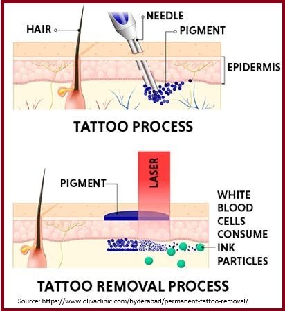 Tattoo Removal Treatment in BandraMumbai at Bliss Skin Clinic