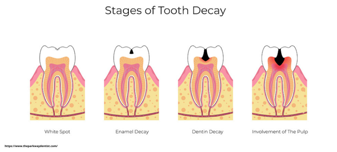 stages of tooth decay stages of tooth decay