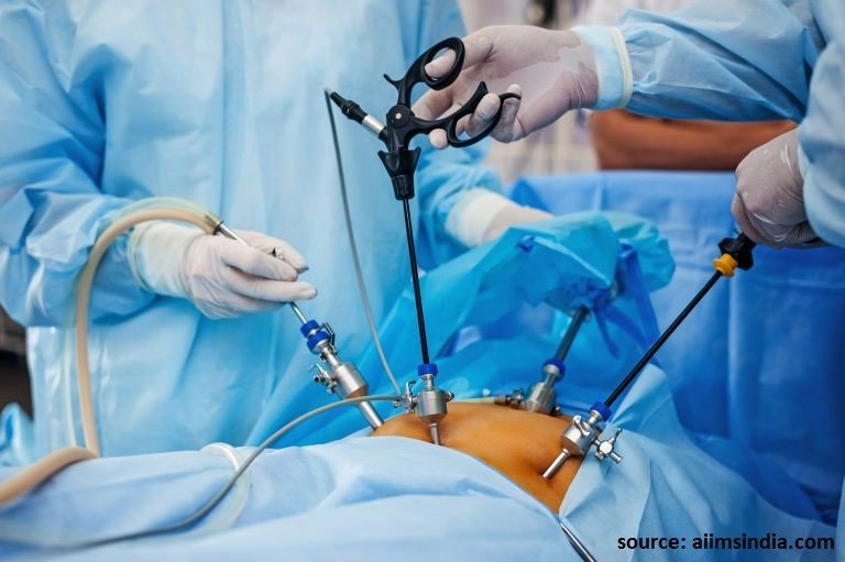 laparoscopic surgery