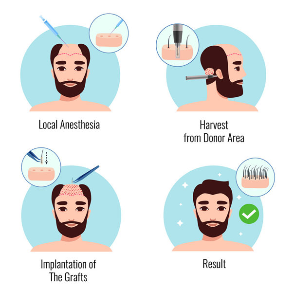 Hair Transplant in Jaipur