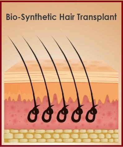 bio-synthetic hair transplant