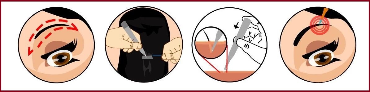 eyebrow hair transplant procedure