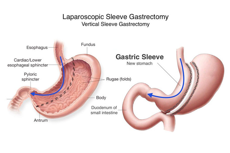 Can gastric sleeve be done twice