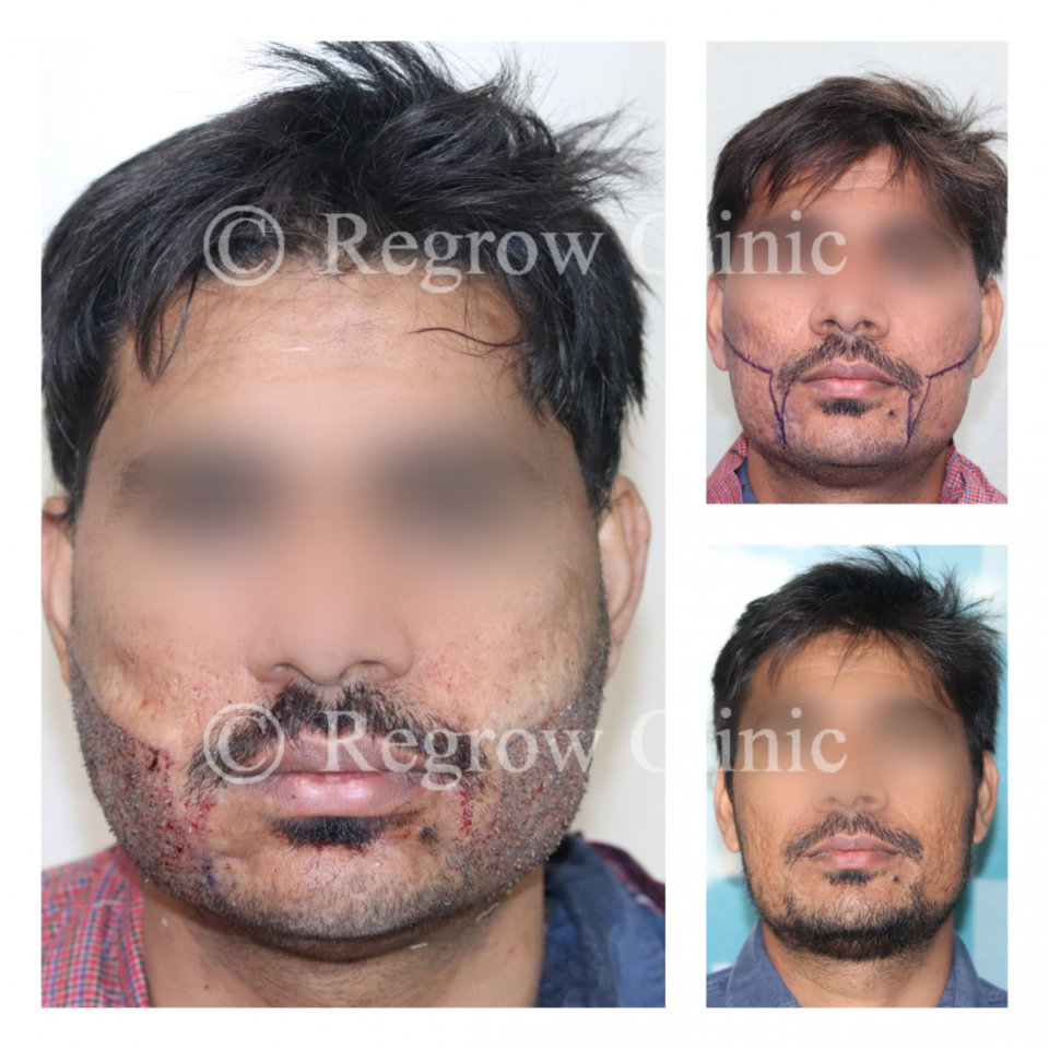 Beard & Mustache Hair Transplant Beard & Mustache Hair Transplant