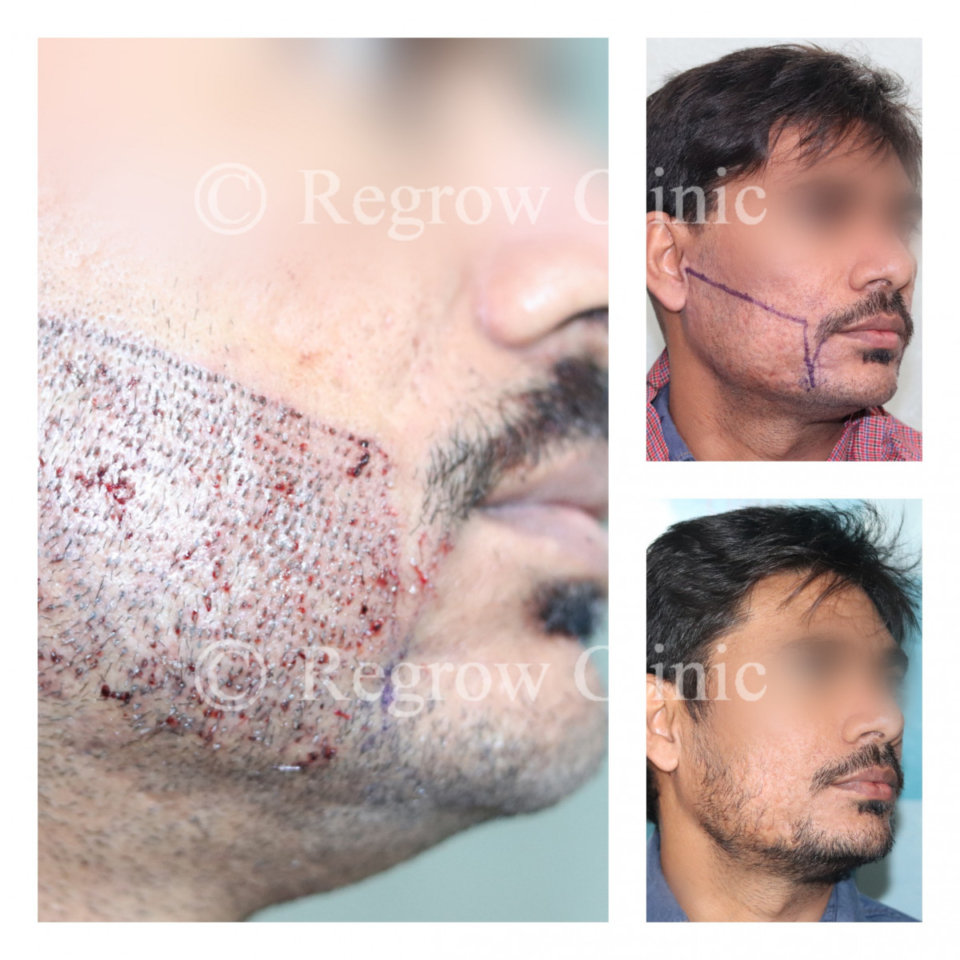 Beard & Mustache Hair Transplant Beard & Mustache Hair Transplant