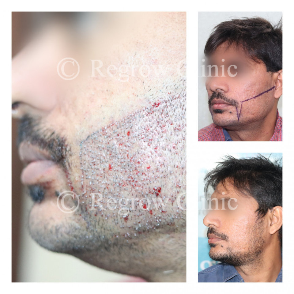 Beard & Mustache Hair Transplant Beard & Mustache Hair Transplant