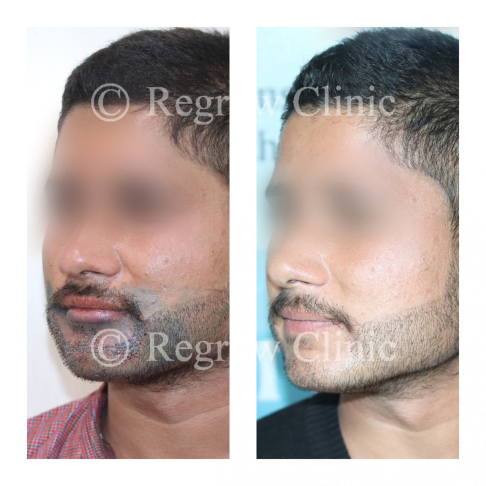 Beard & Mustache Hair Transplant Beard & Mustache Hair Transplant