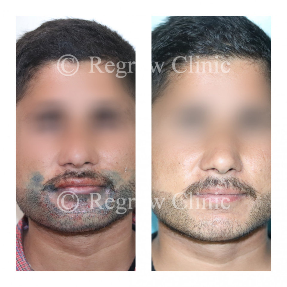 Beard & Mustache Hair Transplant Beard & Mustache Hair Transplant