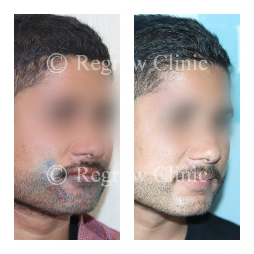 Beard & Mustache Hair Transplant Beard & Mustache Hair Transplant
