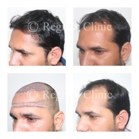 Before - After Treatment Images of Patients Before - After Treatment Images of Patients