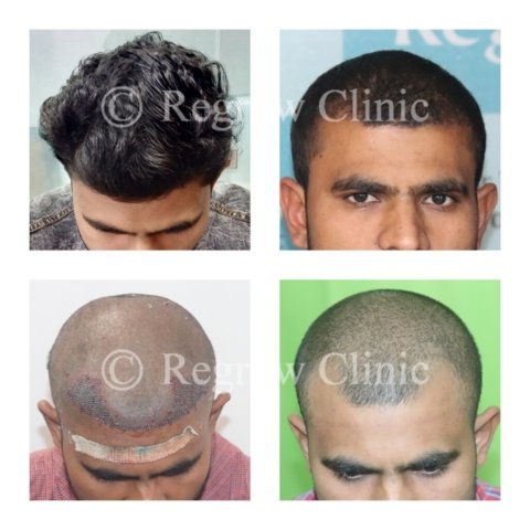 Before - After Treatment Images of Patients Before - After Treatment Images of Patients