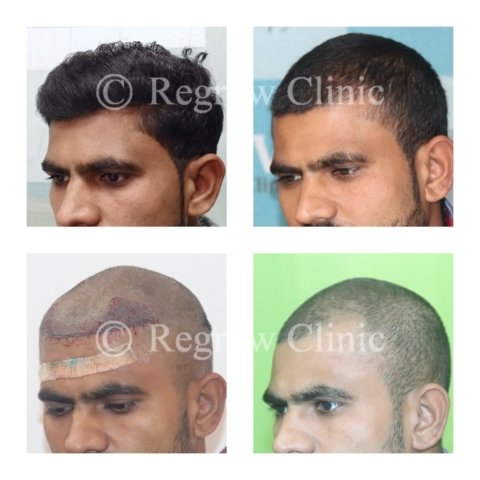 Before - After Treatment Images of Patients Before - After Treatment Images of Patients