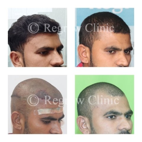 Before - After Treatment Images of Patients Before - After Treatment Images of Patients