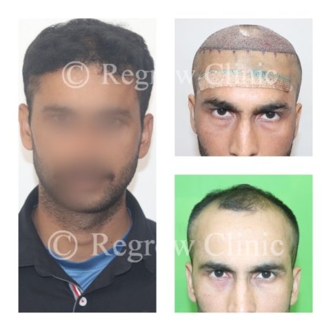 Before - After Treatment Images of Patients Before - After Treatment Images of Patients