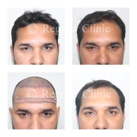 Before - After Treatment Images of Patients Before - After Treatment Images of Patients