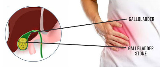 gallbladder treatment
