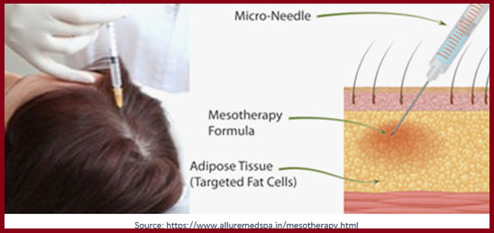 mesotherapy