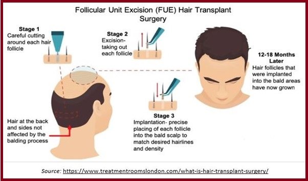 Follicular unit extraction (FUE)