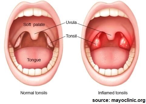 tonsilitis