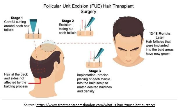 Hair Transplant