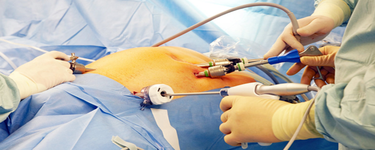 Laparoscopic Gallbladder Surgery Laparoscopic Gallbladder Surgery