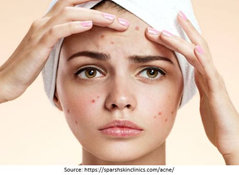 How Is Acne Formed?