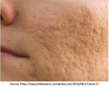 Acne Scars